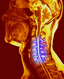 Cervical Vertebrae Prints: Osteochondrosis of the neck bones