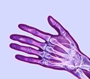 Osteoid osteoma, X-ray Osteoid osteoma, X-ray