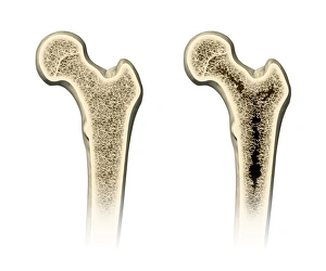 Images Dated 4th August 2011: Osteoporosis Print: Comparative Femur Sections