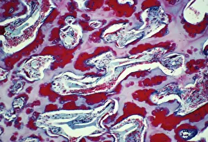 Images Dated 4th April 2003: Osteoporotic bone Print