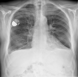 Framed Print : Pacemaker Print, X-ray Image