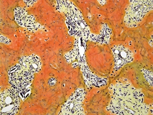 Light Microscopy Images Prints: Pagets disease, light micrograph