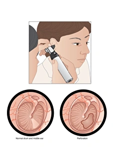 Images Dated 19th August 2010: Perforated Eardrum Print