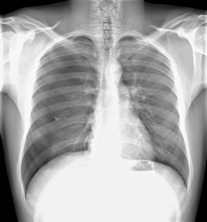 Pneumothorax Print: X-ray of a collapsed lung