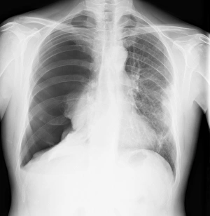 Pneumothorax, X-ray C017/7148 Pneumothorax, X-ray C017/7148