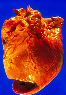 Post-mortem specimen of human heart Post-mortem specimen of human heart