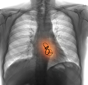 Prosthetic heart valves, X-ray F008/3453 Prosthetic heart valves, X-ray F008/3453
