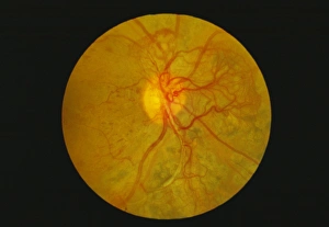 Retina damage in diabetes Retina damage in diabetes