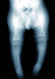 Prints of Rickets. X-ray of the legs of a young child with rickets. This condition, which causes soft bones, is caused by a lack of vitamin D Images Dated 2011 August: X-ray Print of Rickets in a Young Child