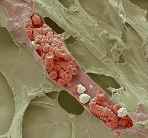Prints of Ruptured venule. Coloured scanning electron micrograph (SEM) of a ruptured venule running through fatty tissue Images Dated 2011 December: Ruptured Venule Print