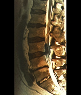 Images Dated 27th March 2013: MRI Print of Herniated Disc Causing Sciatica