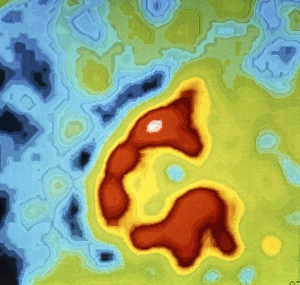 Scintigram showing ischaemia post heart attack Scintigram showing ischaemia post heart attack
