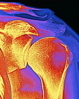 Prints of Shoulder. Coloured X-ray of a healthy shoulder joint Images Dated 2003 February: Coloured X-ray Print of a Healthy Shoulder Joint