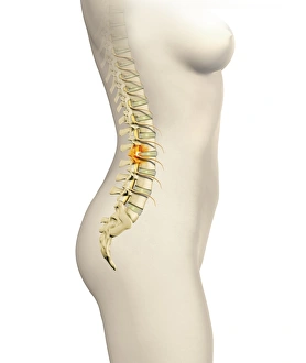Back Pain Causes Prints: Slipped disc, artwork