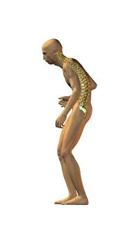 Vertebral Column Illustration Prints: Spinal disorder, artwork