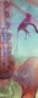 Spinal implant Spinal implant