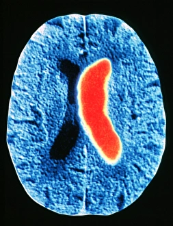 Computed Tomography Scans Prints: Stroke