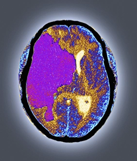 Images Dated 4th March 2013: Coloured CT scan Print of brain damage