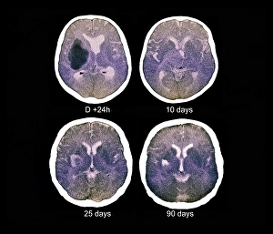Images Dated 27th March 2013: Coloured CT Scan Print of Haemorrhagic Stroke Damage