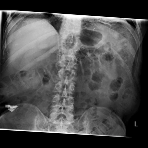 Swallowed key and blades, X-ray C017/7559 Swallowed key and blades, X-ray C017/7559