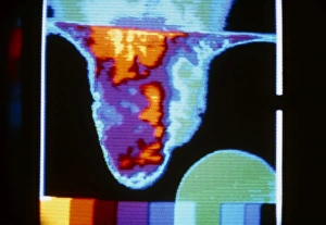 Thermogram of varicocele in right of scrotum Thermogram of varicocele in right of scrotum