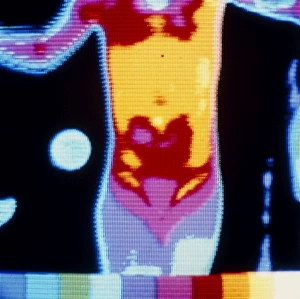 Thermogram of young infant suffering from burns Thermogram of young infant suffering from burns