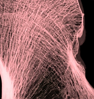 Femur Bone Structure Prints: Thigh bone head, X-ray