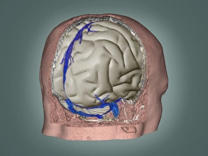 3D CT Scan Print of Brain Thrombophlebitis