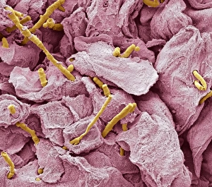 Thrush infection of the tongue, SEM C016/9091 Thrush infection of the tongue, SEM C016/9091