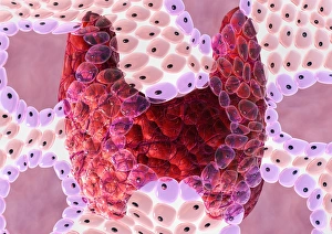 Prints of Thyroid follicles. Computer artwork of cells of thyroid follicles (pink, purple) superimposed on an artwork of the thyroid gland (red, centre) Images Dated 2006 July: Thyroid Follicles Print