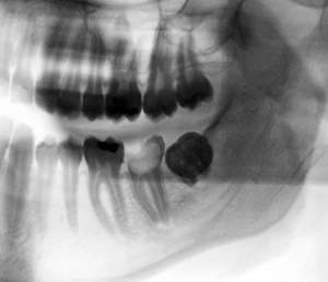 Prints of Tooth decay. Coloured X-ray of a profile view of a 22-year-old patients teeth, showing a cavity (decay) in the left lower molar (light grey, centre left) Images Dated 2011 August: Coloured X-ray Print of Tooth Decay
