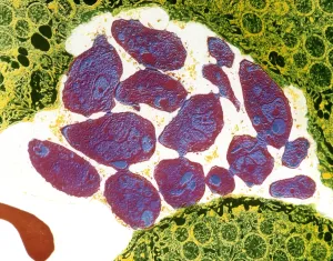 Toxoplasmosis Toxoplasmosis
