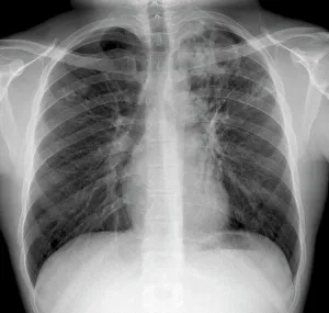 Mycobacterium Tuberculosis Bacteria Prints: Tuberculosis, X-ray