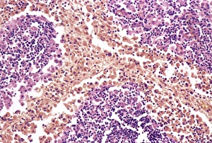 Prints of Typhoid nodules, coloured light micrograph. Section through a lymph node of a patient with typhoid, showing macrophages (large cells, pink) forming typhoid nodules Images Dated 2008 April: Typhoid Nodules Print, Coloured Light Micrograph