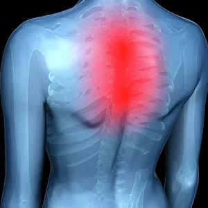 Upper Back Pain Print