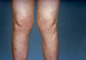 Images Dated 2nd July 2003: View of knees affected by osteoarthritis