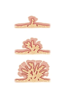 Images Dated 7th February 2013: Wart forming on skin Print