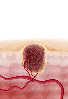 Images Dated 12th November 2012: Human skin cross-section with wart, Print