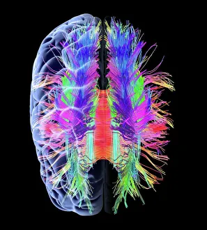 White matter fibres and brain, artwork C015/1930 White matter fibres and brain, artwork C015/1930