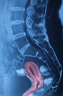 Female Reproductive System Prints: Womb, CT scan