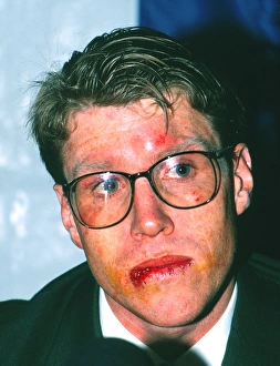 Australia captain Nick Farr-Jones shows his battle scars after the 3rd Test - 1989 Australia captain Nick Farr-Jones shows his battle scars after the 3rd Test - 1989