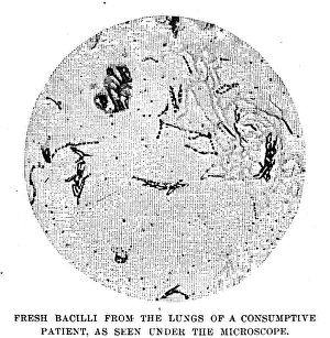 Engraving after a drawing by Robert Koch of fresh bacilli from the lungs of a Engraving after a drawing by Robert Koch of fresh bacilli from the lungs of a