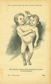 Siamese or conjoined twins. Chang and Eng Siamese or conjoined twins. Chang and Eng