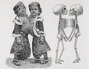 Siamese or Conjoined twins Radica - Doodica Siamese or Conjoined twins Radica - Doodica