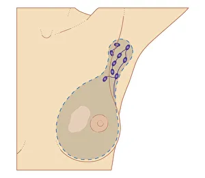 Cross section biomedical illustration of breast cancer tumour and lymph nodes requiring mastectomy procedure Cross section biomedical illustration of breast cancer tumour and lymph nodes requiring mastectomy procedure