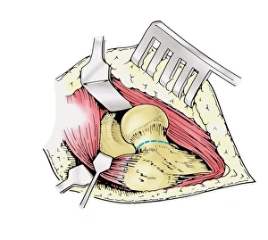 Diagram showing removal of affected head of a femur bone Diagram showing removal of affected head of a femur bone