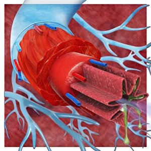 Digital cross section illustration of trachea and bronchioles in human lung of asthmatic Digital cross section illustration of trachea and bronchioles in human lung of asthmatic