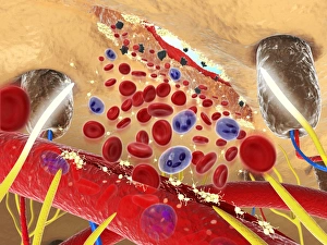 Digital cross section illustration wound below human skin showing red and white blood cells and yell Digital cross section illustration wound below human skin showing red and white blood cells and yell