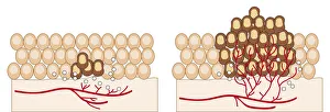 Digital illustration of angiogenesis process showing dormant tumour invading tissue Digital illustration of angiogenesis process showing dormant tumour invading tissue