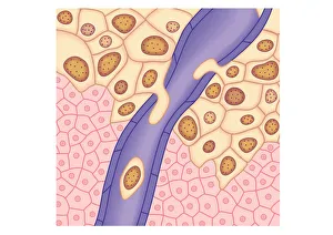 Digital illustration of breached lymph vessel as primary tumour grows Digital illustration of breached lymph vessel as primary tumour grows